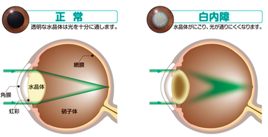 白内障の症状について