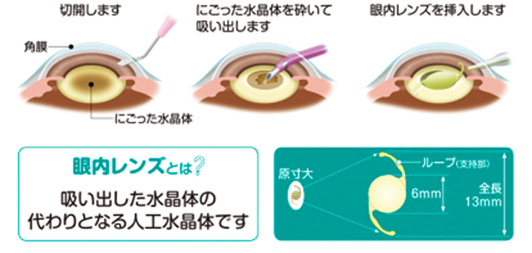 手術は局所麻酔で顕微鏡を使って行います